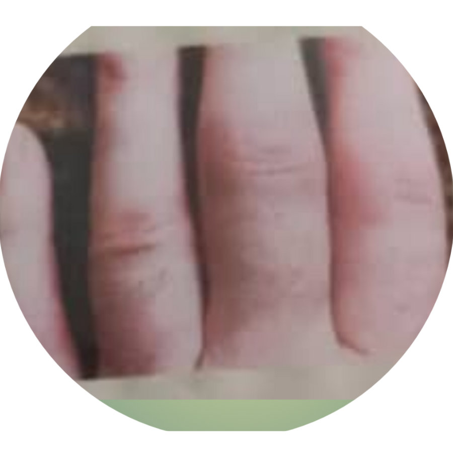 Arthritis Patient
