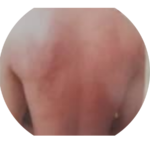 body allergic reaction